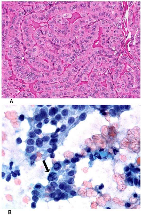 TALL CELL VARIANT OF PTC Papillary formations are lined by tumor cells with eosinophilic cytoplasm and cell height 2 3 times the width A H&E stain, 60 Fine needle aspiration of