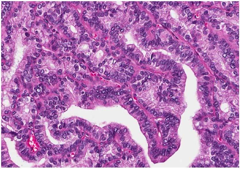 COLUMNAR CELL VARIANT OF PTC Papillary formation, hyperchromatic elongated nuclei and