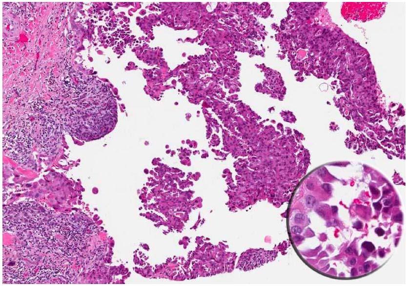 HOBNAIL VARIANT OF PTC Tumor with papillary growth pattern; the inset shows some of the tumor cell nuclei are eccentrically placed causing bulging of the