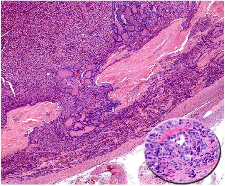 DIFFUSE FOLLICULAR VARIANT OF PTC A solid and follicular growth pattern tumor demonstrating widespread invasion.