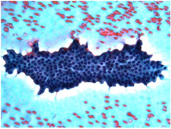 THYROID FNA : benign Thyroid FNA demonstrating a macrofollicular group of cells in a background of abundant watery