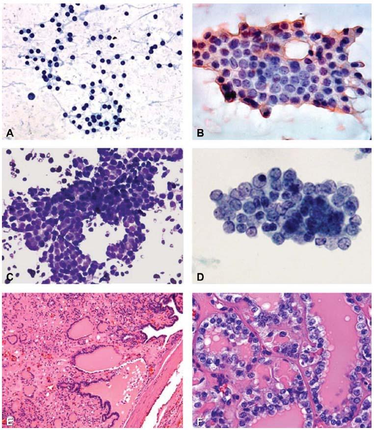 A case diagnosed as FLUS/AUS on initial FNA The majority of the specimen showed features of nodular goiter (A: Pap stained alcohol-fixed smear, X10) However, one group of follicular cells displayed