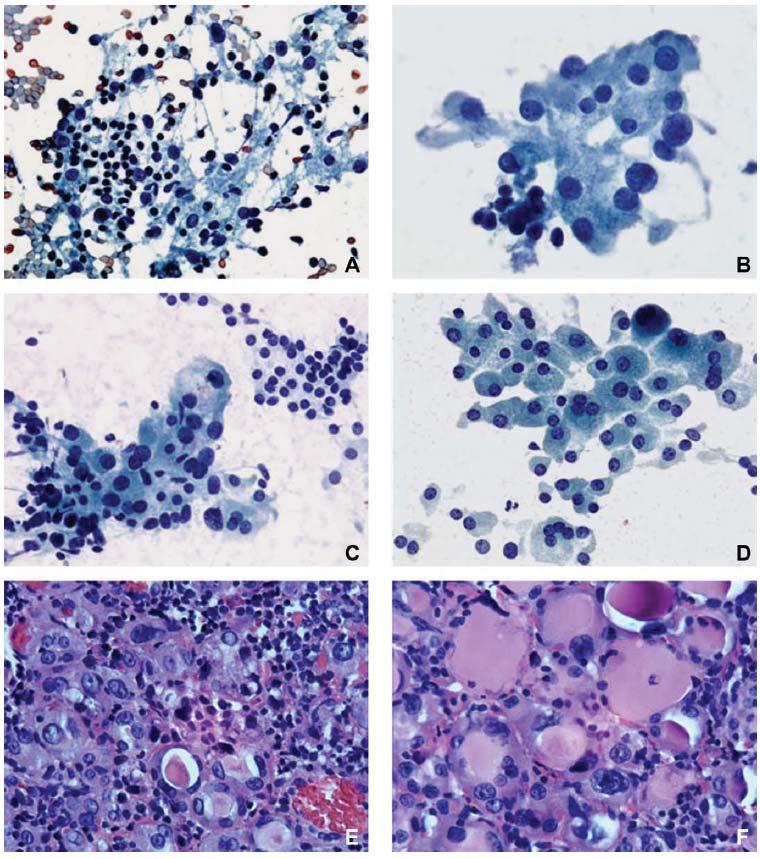 A case diagnosed as FLUS/AUS due to the presence of oncocytic follicular cells with nuclear pleomorphism Notice the lymphocytic infiltrate indicating an element of chronic lymphocytic thyroiditis A)