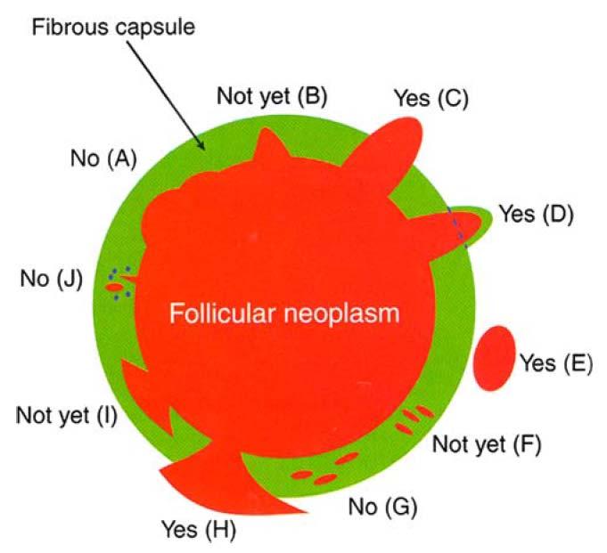 CAPSULAR INVASION (CI) Schematic drawing for the interpretation of the presence or absence of CI. The diagram depicts a follicular neoplasm (orange) surrounded by a fibrous capsule (green).