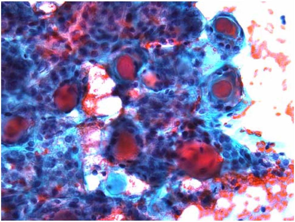 FOLLICULAR NEOPLASM Thyroid FNA showing follicular cells in a predominantly microfollicular arrangement This