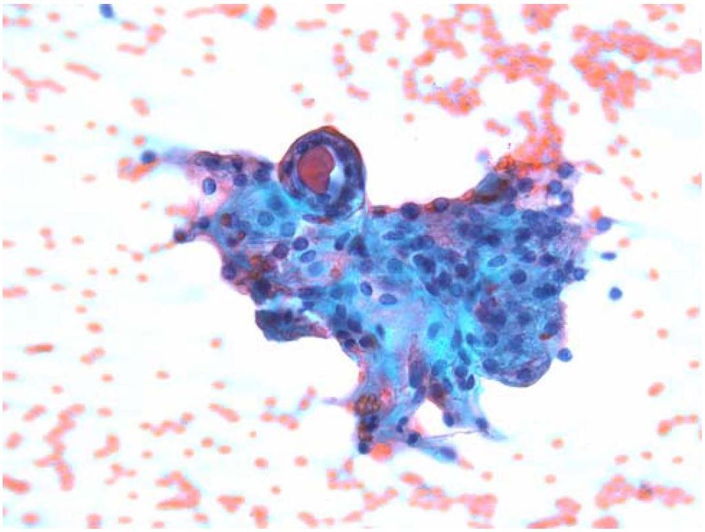 ACUS: ATYPICAL CELLS OF UNDETERMINED SIGNIFICANCE Thyroid FNA demonstrating an