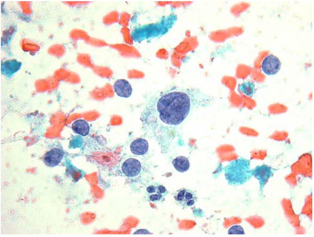 ACUS: ATYPICAL CELLS OF UNDETERMINED SIGNIFICANCE Thyroid FNA containing occasional follicular cells with enlarged,