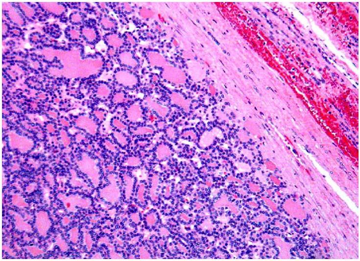 Encapsulated follicular-patterned neoplasm without capsular and/or vascular invasion