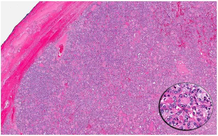 ENCAPSULATED FOLLICULAR VARIANT OF PAPILLARY THYROID CARCINOMA demonstrating diffuse distribution of nuclear
