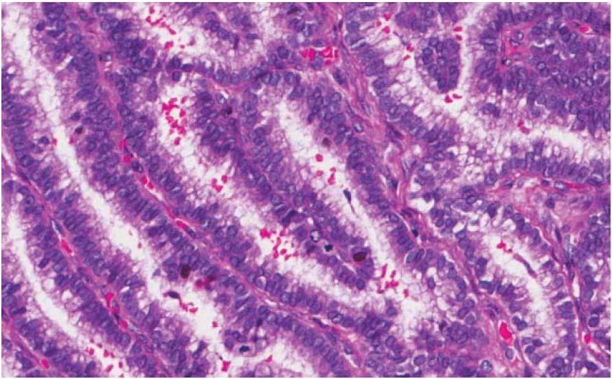 Columnar-cell variant of PTC Figure 3. In a sample of the columnar-cell variant of papillary thyroid carcinoma, the tumor exhibits elongated follicles with nuclei arranged in parallel cords.