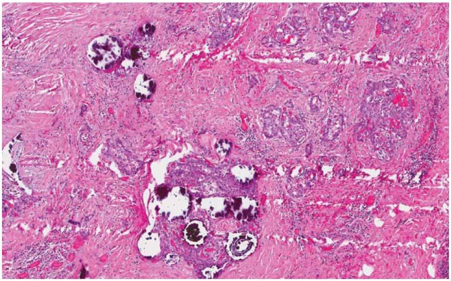 Diffuse sclerosing variant of PTC Lastra RR, LiVolsi VA, Baloch ZW. Cancer (Cancer Cytopathology) 2014;122:484-503 Figure 5.