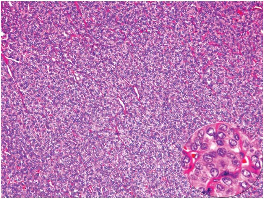Solid variant of PTC Lastra RR, LiVolsi VA, Baloch ZW. Cancer (Cancer Cytopathology) 2014;122:484-503 Figure 7.