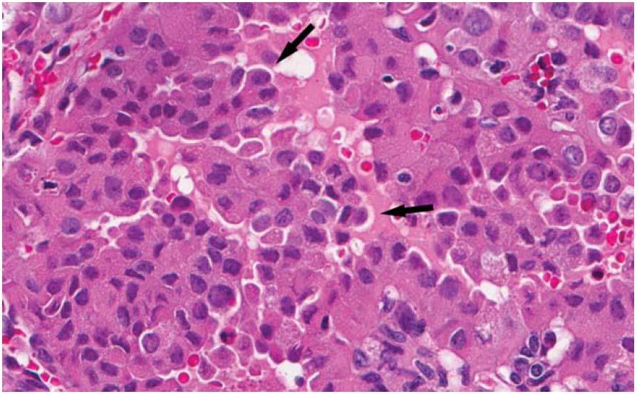 Hobnail variant of PTC Lastra RR, LiVolsi VA, Baloch ZW. Cancer (Cancer Cytopathology) 2014;122:484-503 Figure 9.
