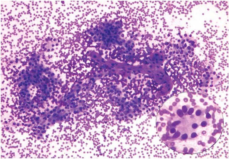 Hobnail variant of PTC Lastra RR, LiVolsi VA, Baloch ZW. Cancer (Cancer Cytopathology) 2014;122:484-503 Figure 10.