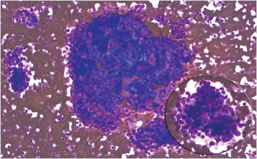 Poorly differentiated thyroid carcinoma Figure 11.