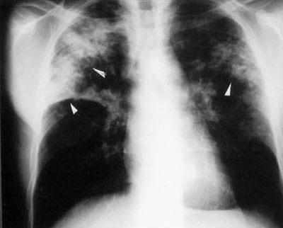 Smoking and Tuberculosis Smoking and Pulmonary TB Smoking is a risk factor for the development of pulmonary TB 4.0 Odds Ratio (95% CI) a 3.0 2.0 1.0 1.00 2.24 0.