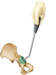 TANDEM Bipolar Hip System Surgical Technique Acetabular Measurement To estimate acetabular size, use preoperative templates or measure the excised femoral head with ID/OD gauges or calipers.