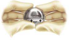 Femoral Head Selection For instrument simplicity, all bipolar trialing utilizes 28mm trial femoral heads.