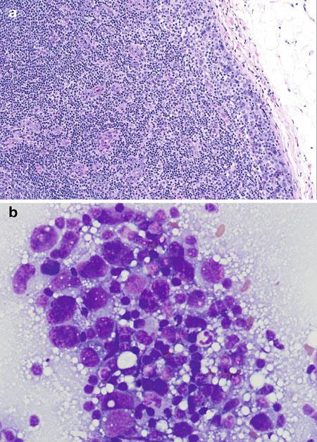 70 FROZEN SECTION LIBRARY: LYMPH NODES FIGURE 5.1 Anaplastic large-cell lymphoma with prominent sinusoidal involvement.