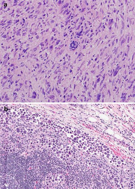 72 FROZEN SECTION LIBRARY: LYMPH NODES FIGURE 5.3 Different morphologies of metastatic melanoma.