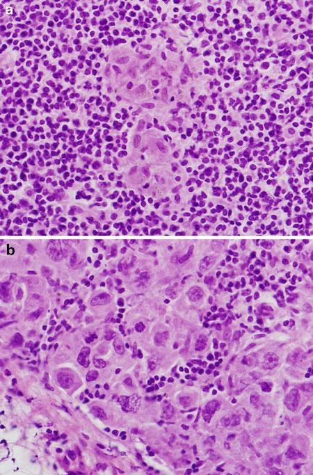APPLICATIONS OF FROZEN SECTION 81 FIGURE 5.7 Cytologic distinction between sinus histiocytes and metastatic carcinoma.