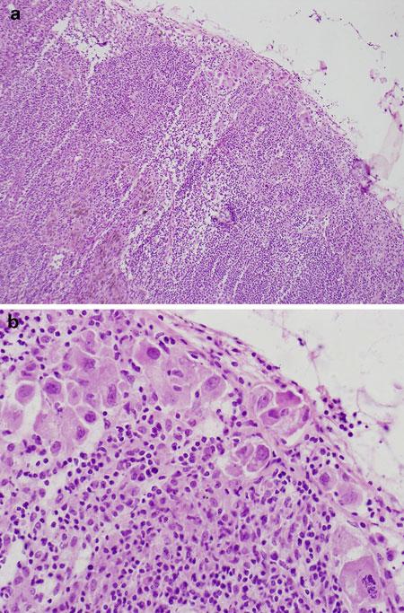 APPLICATIONS OF FROZEN SECTION 83 FIGURE 5.9 Subtle subcapsular sinus involvement by metastatic carcinoma.