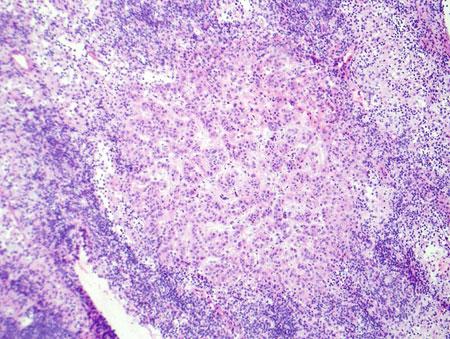 FIGURE 5.10 Metastatic carcinoma involving the lymph node parenchyma.