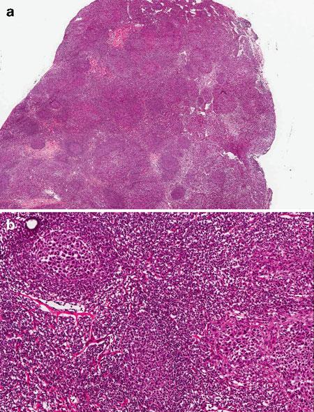 APPLICATIONS OF FROZEN SECTION 85 FIGURE 5.12 Metastatic carcinoma with a nodular growth pattern.
