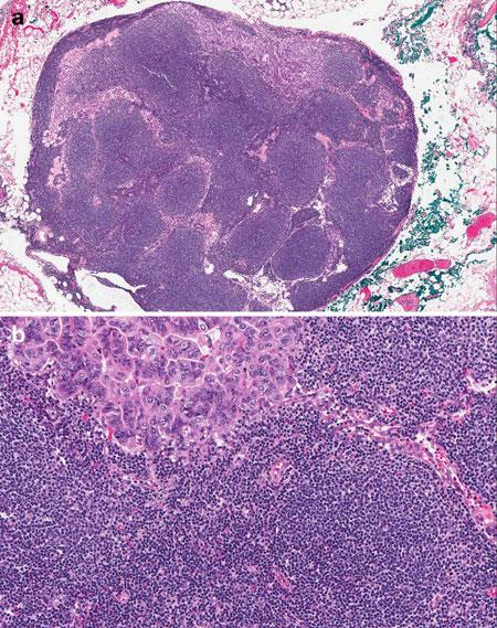 APPLICATIONS OF FROZEN SECTION 89 FIGURE 5.17 Metastatic carcinoma in a lymph node involved by follicular lymphoma, grade 1.