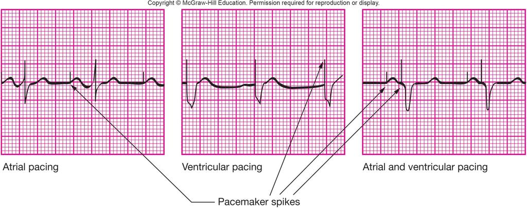 10.2 Types of Pacing Spikes