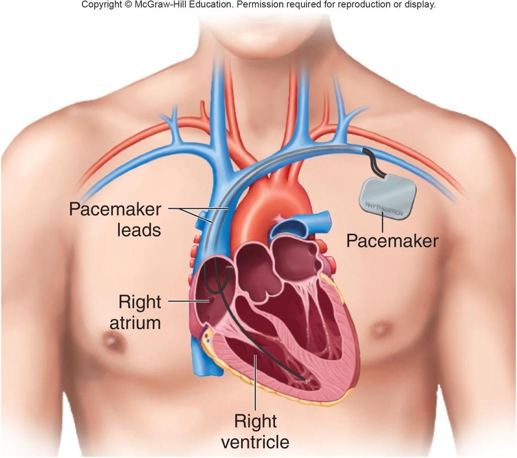 10.1 Types of Pacemakers (Cont.