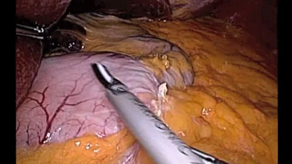 Surgical technique 10 years ago Long-term results of gastric