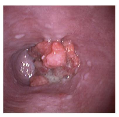 Adenocarcinoma 5 years after SG No reflux