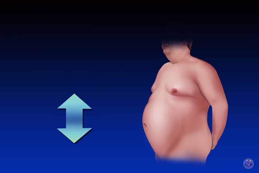 NAFLD Associated with Metabolic Syndrome Visceral Obesity Insulin