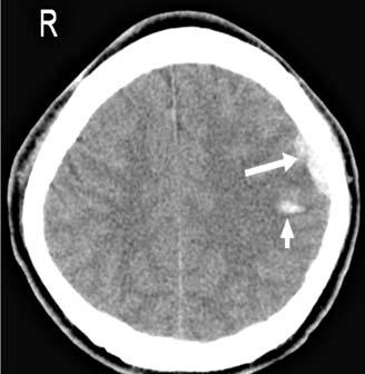 3), but none had intracranial complications in 26 cases without visible fractures on radiographs (Table 6). Table 4.