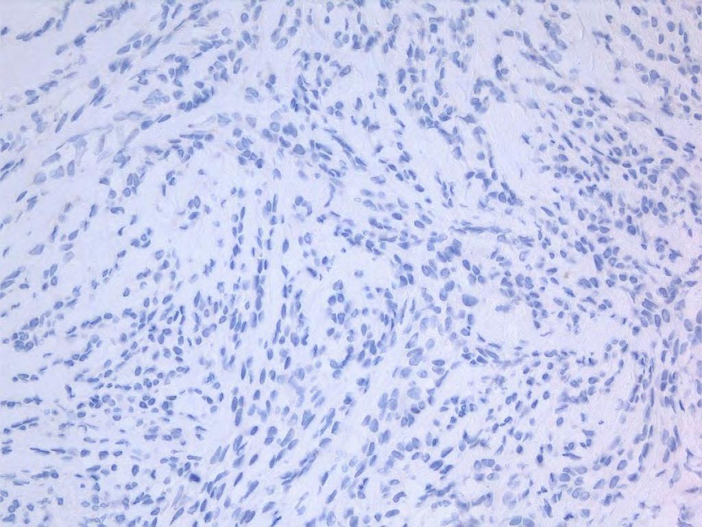 Anaplastic Spindle Cell