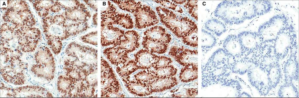 Aberrant TTF-1 expression in 5% of colon carcinomas when using clones SPT24 and