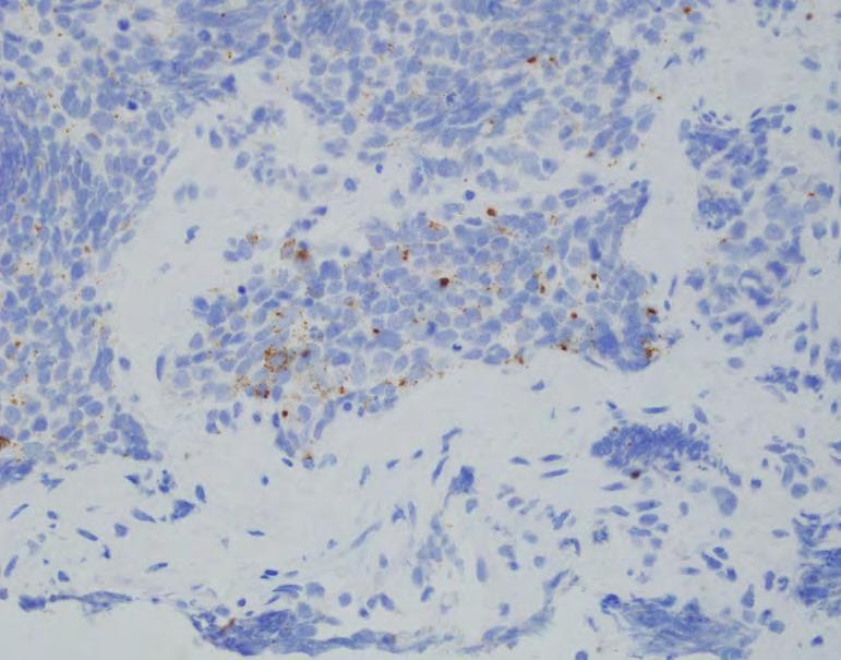 SCLC: some annoying realities Chromogranin staining in