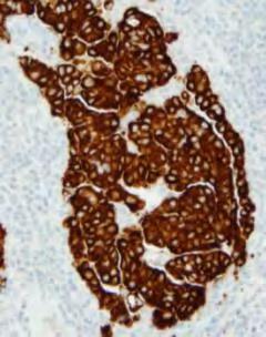 Immunohistochemistry (IHC) is an equivalent alternative to FISH for ALK testing.