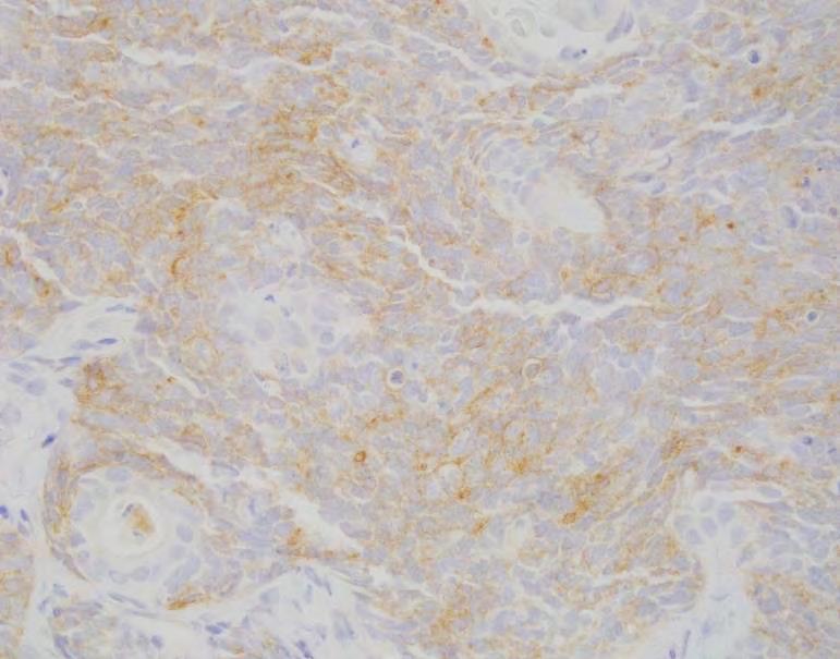 adenocarcinoma-small cell