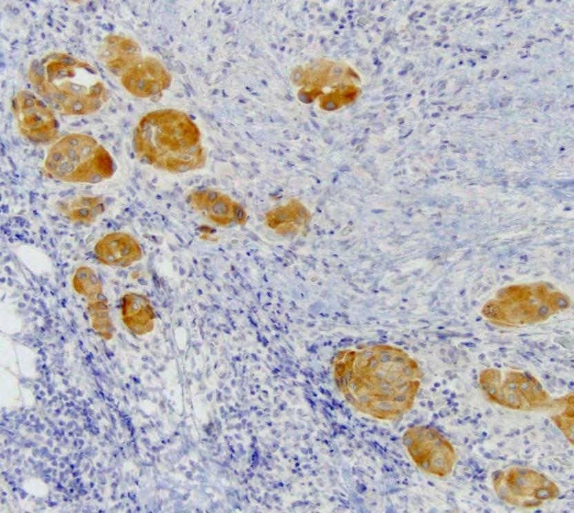 ROS1 IHC should be used