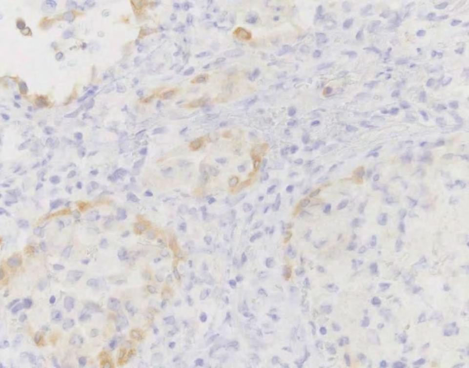 ROS1 IHC pitfalls Low level endogenous ROS1 expression seen in some lung tumors lacking ROS1 rearrangements Reactive
