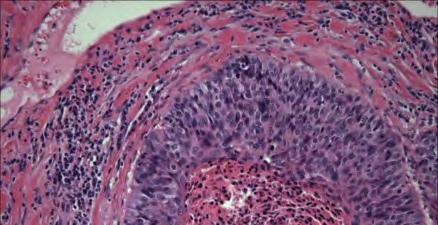 Small cell carcinoma Adenocarcinoma Squamous cell carcinoma Very aggressive/poor prognosis Largely confined to heavy