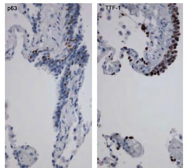 P63 vs TTF1 in normal lung P63 expressed in airway basal cells, metaplastic epithelium; absent in