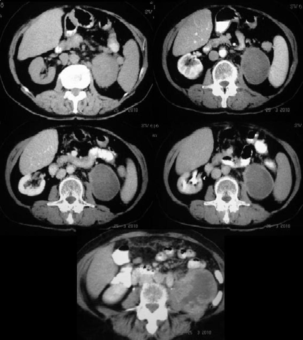 Fig. 2: RCC in the left kidney of a 62 year old male patient; it was a stage III lesion, showing