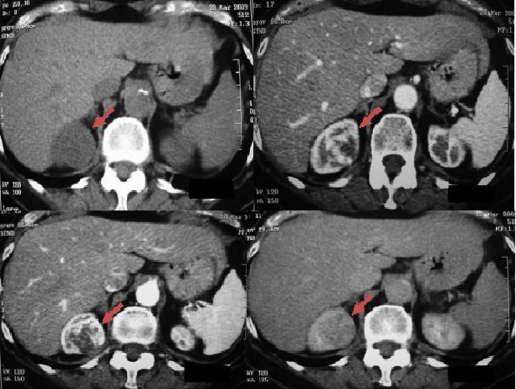 Fig. 1: CT of the abdomen of a 56 year old male patient with RCC in the right kidney.