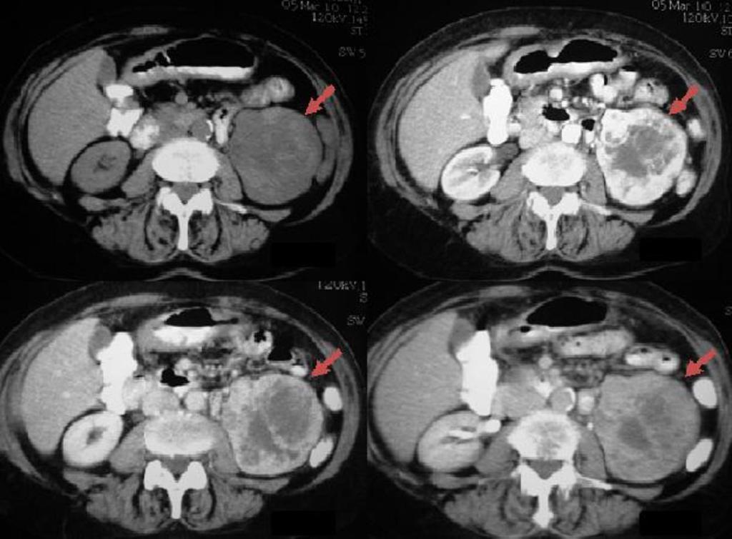 Fig. 2: CT of the abdomen with intravenous contrast material showing a large RCC in the left kidney.