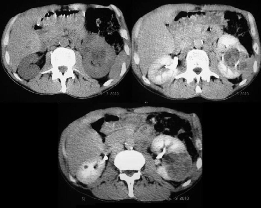 Fig. 3: CT of the abdomen with intravenous contrast material of a 53 year old man who had abdominal pain and hematuria.