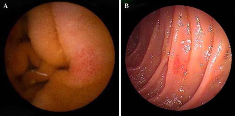 Varices/reticulate pattern, N (%) esophageal endoscopic treatment, current administration of beta-blockers, or Child Pugh Class C.