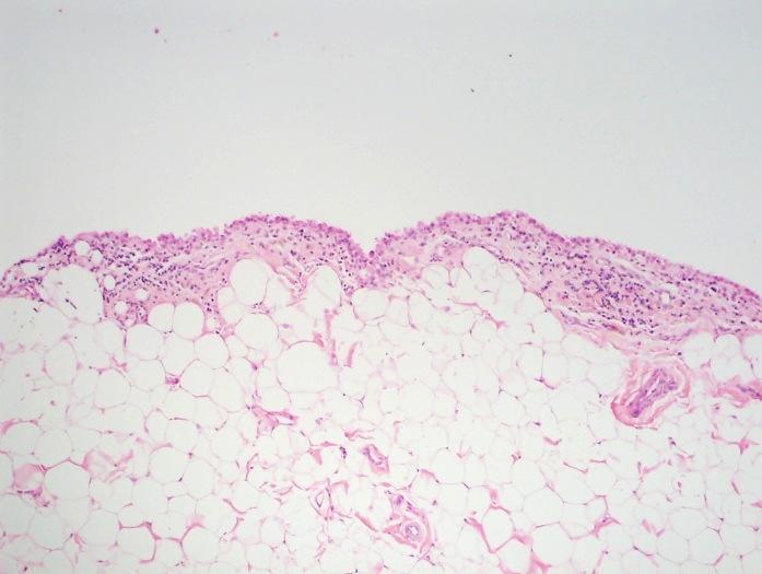 characteristics SECTION AFFECTED 1/3 1/3 1/3 A No inflammatory cell infiltration 0 0 0 B Mild to